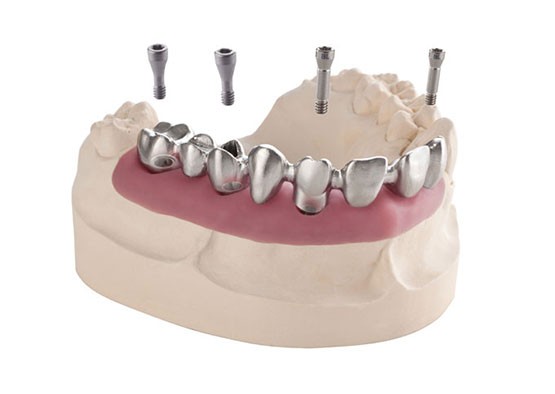 Implant restoration