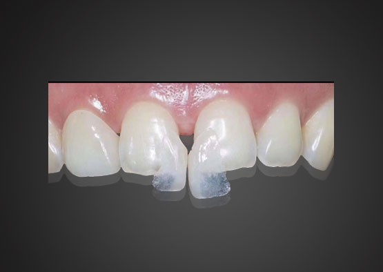 Yimei ultra-thin Venee