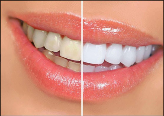 Yimei ultra-thin Venee